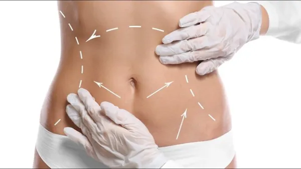 مراقبتهای بعد از عمل ابدومینوپلاستی