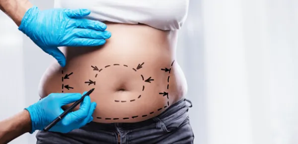 افراد مناسب ابدومینوپلاستی