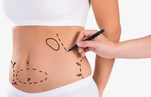 افراد مناسب ابدومینوپلاستی