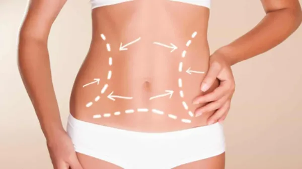 افراد مناسب ابدومینوپلاستی