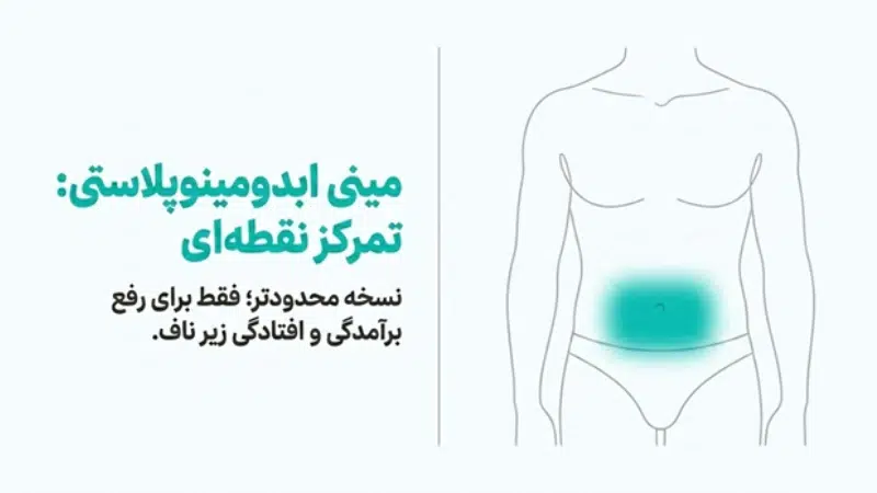 عمل ابدومینوپلاستی نیمه یا مینی ابدو