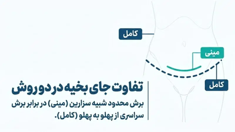 عمل ابدومینوپلاستی نیمه یا مینی ابدو