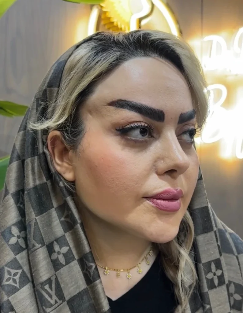 10 روز بعد از ساکشن غبغب - بعد