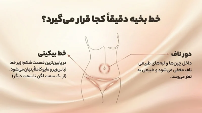 جای بخیه ابدومینوپلاستی