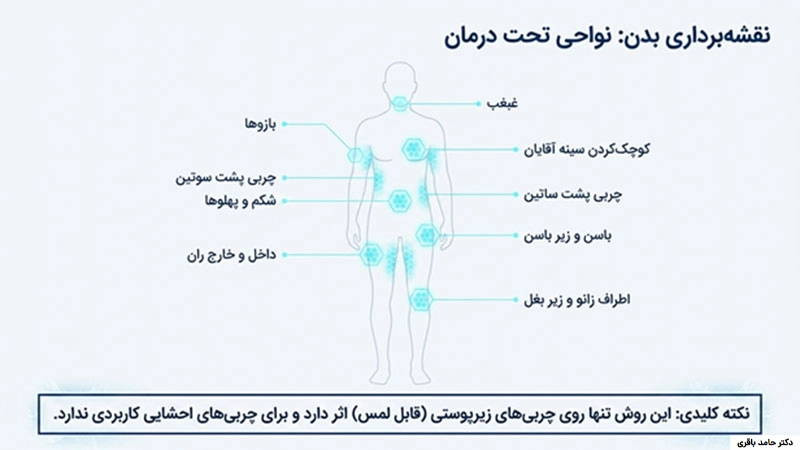 فریزکردن چربی یا کرایولیپولیز