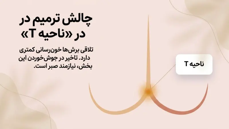 بررسی عوارض مهم و اولیه ماموپلاستی