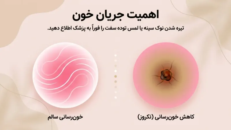نکروز نوک سینه و چربی
