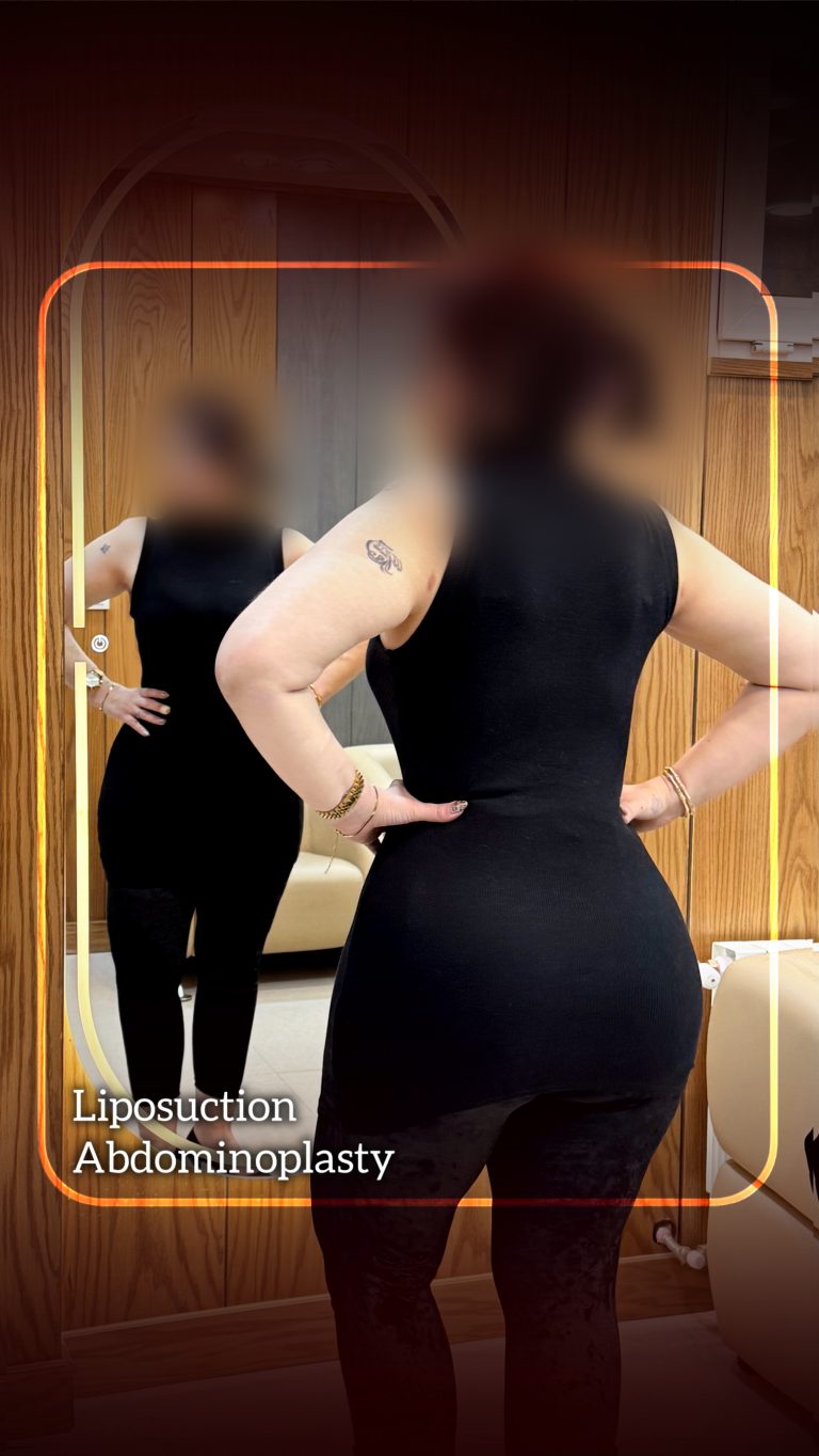 تغییر شگفت‌انگیز فرم بدن تنها دو ماه پس از جراحی!