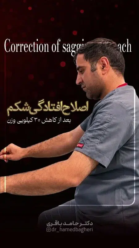 اصلاح افتادگی پوست بعد از ۳۰ کیلو کاهش وزن