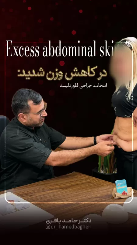 افتادگی شدید پوست بعد از کاهش وزن ۴۰ کیلویی